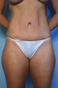 Abdominoplasty
