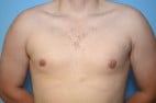 Gynecomastia