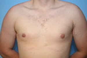 Gynecomastia