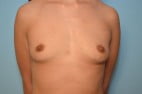 Breast Augmentation