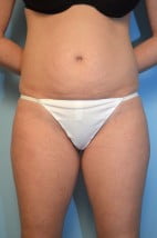 Umbilical Float Tummy Tuck