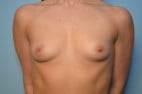 Breast Augmentation