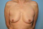 Breast Augmentation