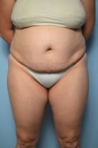 Lipoabdominoplasty