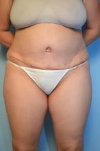 Lipoabdominoplasty