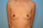 Breast Augmentation