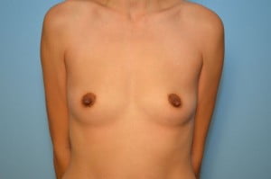 Breast Augmentation