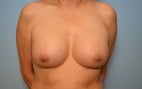 Breast Augmentation