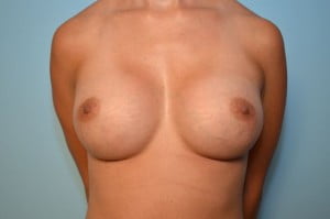 Breast Augmentation
