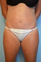 Umbilical Float Tummy Tuck