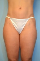 Liposuction Lateral Thighs