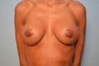 Breast Implant Exchange and Revision
