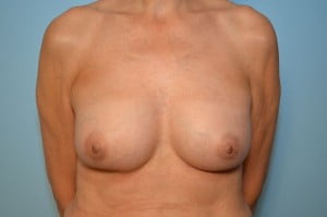 Breast Implant Exchange and Breast Revision
