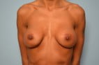 Breast Implant Exchange and Revision