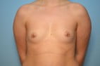 Breast Augmentation