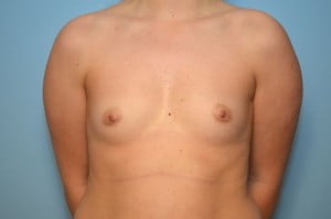 Breast Augmentation