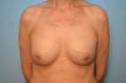 Breast Implant Exchange and Breast Revision