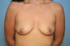 Breast Augmentation