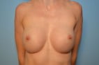 Breast Augmentation