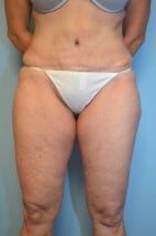 Umbilical Float Tummy Tuck