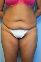 Lipoabdominoplasty