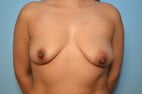 Breast Augmentation Breast Lift