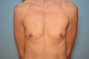 Breast Augmentation