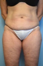 Umbilical Float Tummy Tuck