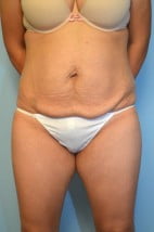 Tummy Tuck, Liposuction Abdomen and Flanks