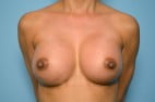 Breast Augmentation