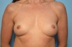 Breast Augmentation