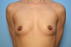 Breast Augmentation