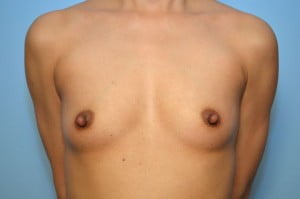 Breast Augmentation