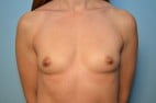 Breast Augmentation