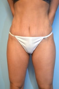 Umbilical Float Tummy Tuck + Liposuction