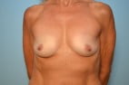 Breast Augmentation