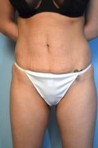 Umbilical Float Tummy Tuck + Liposuction