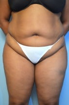 Liposuction