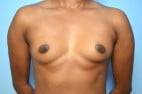 Breast Augmentation