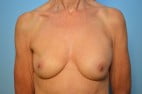 Breast Implant Removal and Capsullectomies
