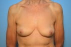 Breast Implant Removal and Capsullectomies