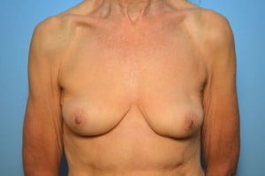 Breast Implant Removal and Capsullectomies