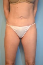 Umbilical Float Tummy Tuck