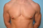 Gynecomastia Reduction