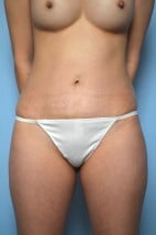 Umbilical Float Tummy Tuck