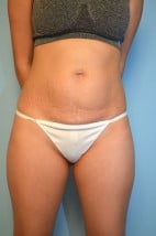 Umbilical Float Tummy Tuck