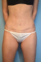 Umbilical Float Tummy Tuck