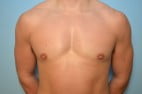 Gynecomastia Reduction