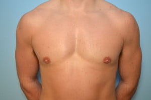 Gynecomastia Reduction