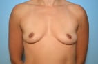 Breast Augmentation